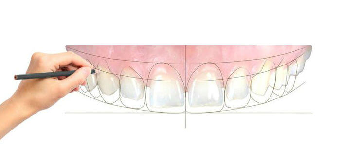 Smile Design